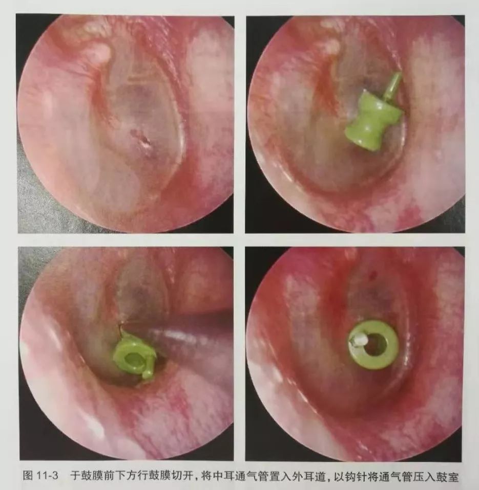 快速掌握鼓膜切开置管术的手术要点