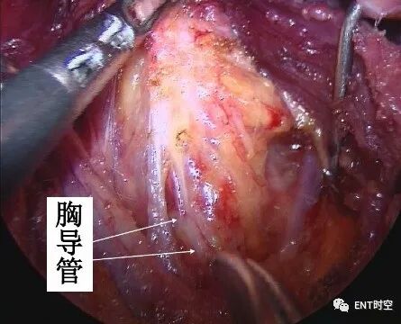 手术室体位垫怎么用手术精讲：图文详解甲状腺手术（含腔镜下手术）_https://www.jmylbn.com_新闻资讯_第35张