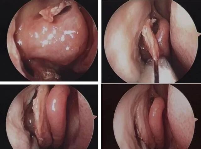 操作鼻窦镜时怎么摆基础必备 丨 鼻内镜鼻窦手术的操作过程详解_https://www.jmylbn.com_新闻资讯_第8张
