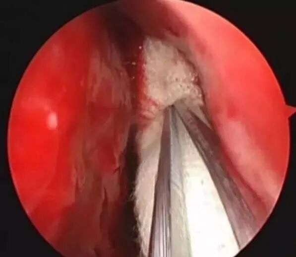 操作鼻窦镜时怎么摆基础必备 丨 鼻内镜鼻窦手术的操作过程详解_https://www.jmylbn.com_新闻资讯_第14张