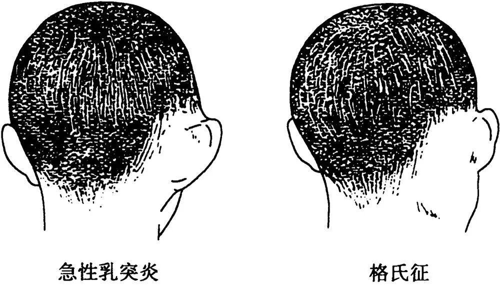 9 栊部脓肿慢性乳突炎主要是乳突气房骨质增生,骨壁硬化,成硬化型乳突