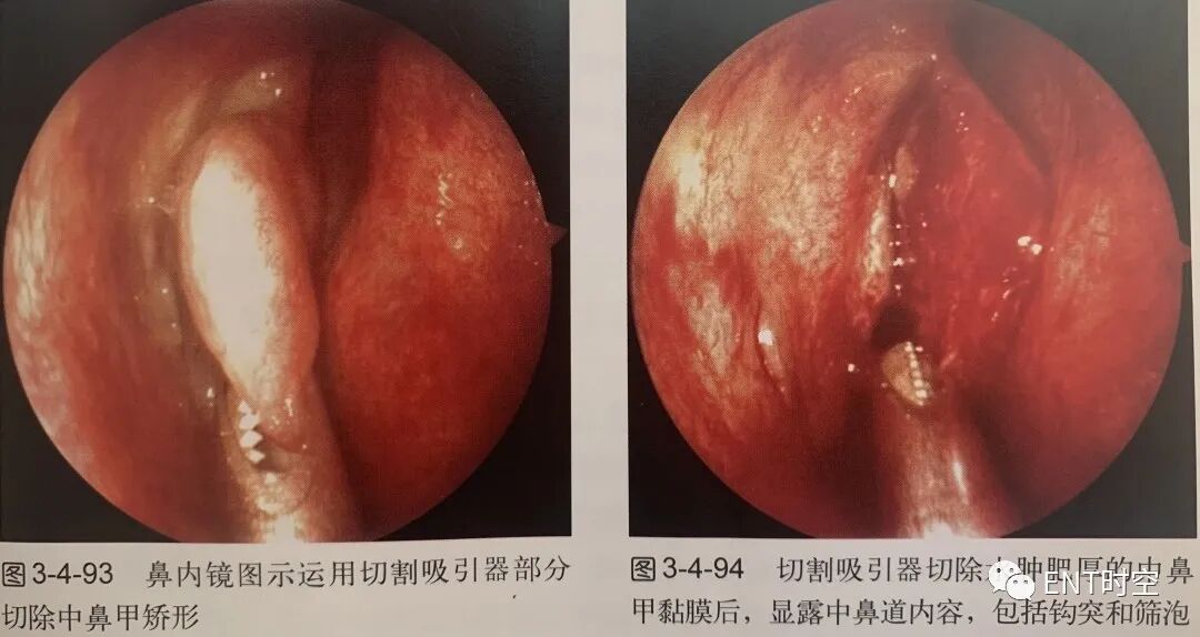 鼻内镜手术中,正确处理中鼻甲是多么重要_医学界-助力医生临床决策和