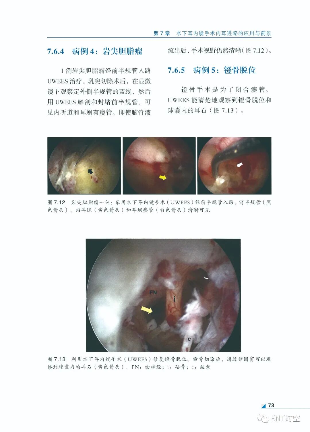 手术电钻怎么用堪称“了不起”的耳内镜手术！术前影像学诊断、耳黏膜及鼓膜再生、电钻和超声骨刀技术......超实用！_https://www.jmylbn.com_新闻资讯_第15张