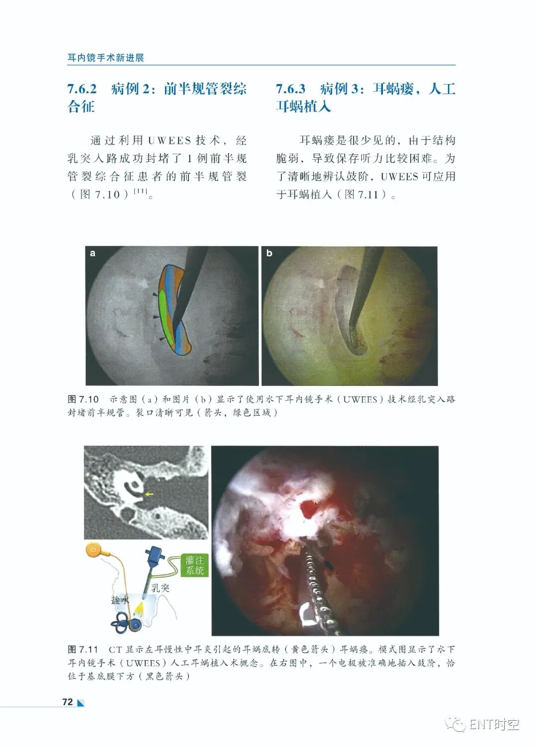 手术电钻怎么用堪称“了不起”的耳内镜手术！术前影像学诊断、耳黏膜及鼓膜再生、电钻和超声骨刀技术......超实用！_https://www.jmylbn.com_新闻资讯_第14张
