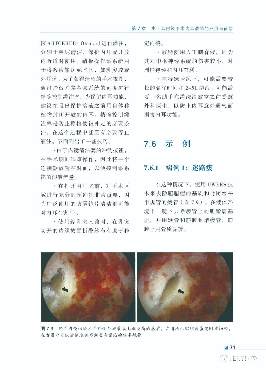 手术电钻怎么用堪称“了不起”的耳内镜手术！术前影像学诊断、耳黏膜及鼓膜再生、电钻和超声骨刀技术......超实用！_https://www.jmylbn.com_新闻资讯_第13张