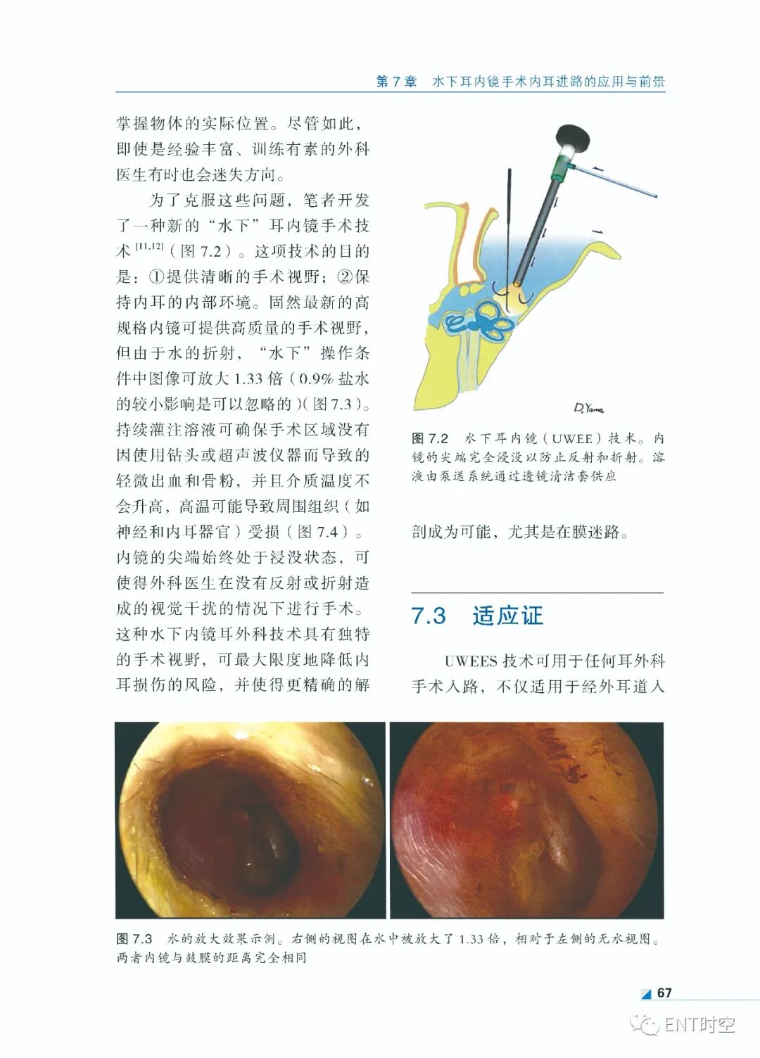 手术电钻怎么用堪称“了不起”的耳内镜手术！术前影像学诊断、耳黏膜及鼓膜再生、电钻和超声骨刀技术......超实用！_https://www.jmylbn.com_新闻资讯_第10张