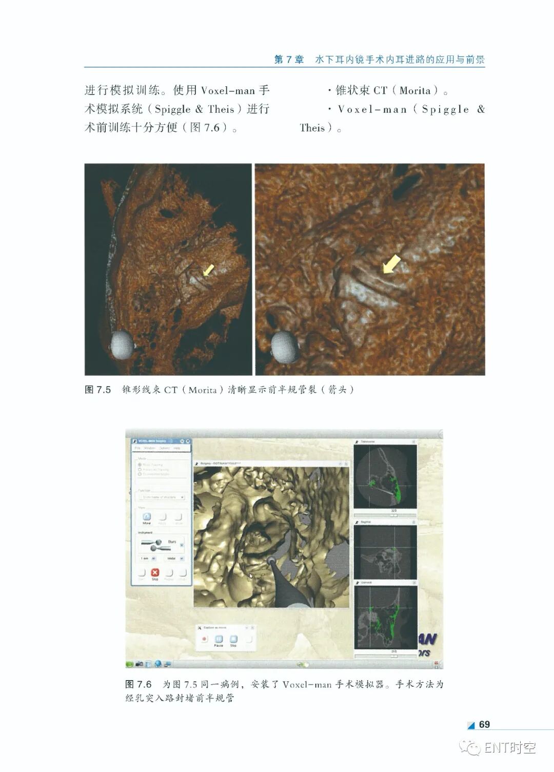 手术电钻怎么用堪称“了不起”的耳内镜手术！术前影像学诊断、耳黏膜及鼓膜再生、电钻和超声骨刀技术......超实用！_https://www.jmylbn.com_新闻资讯_第12张