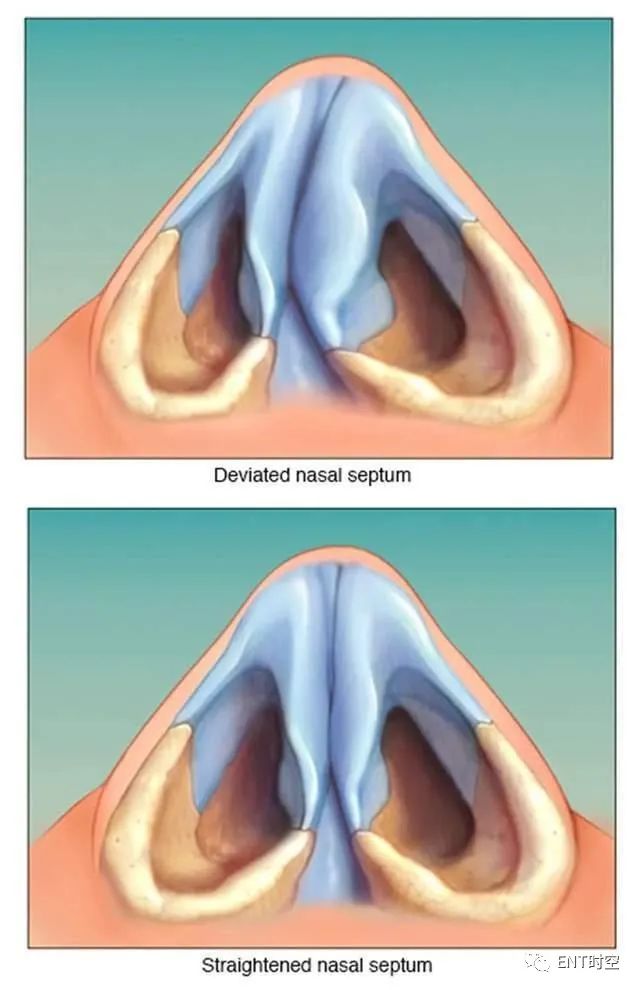 deviated septum图片