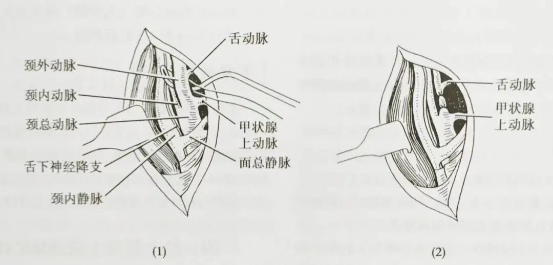 怎么结扎血管面对鼻出血：7种关键血管结扎手术技巧！_https://www.jmylbn.com_新闻资讯_第3张