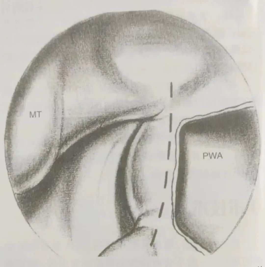 怎么结扎血管面对鼻出血：7种关键血管结扎手术技巧！_https://www.jmylbn.com_新闻资讯_第8张