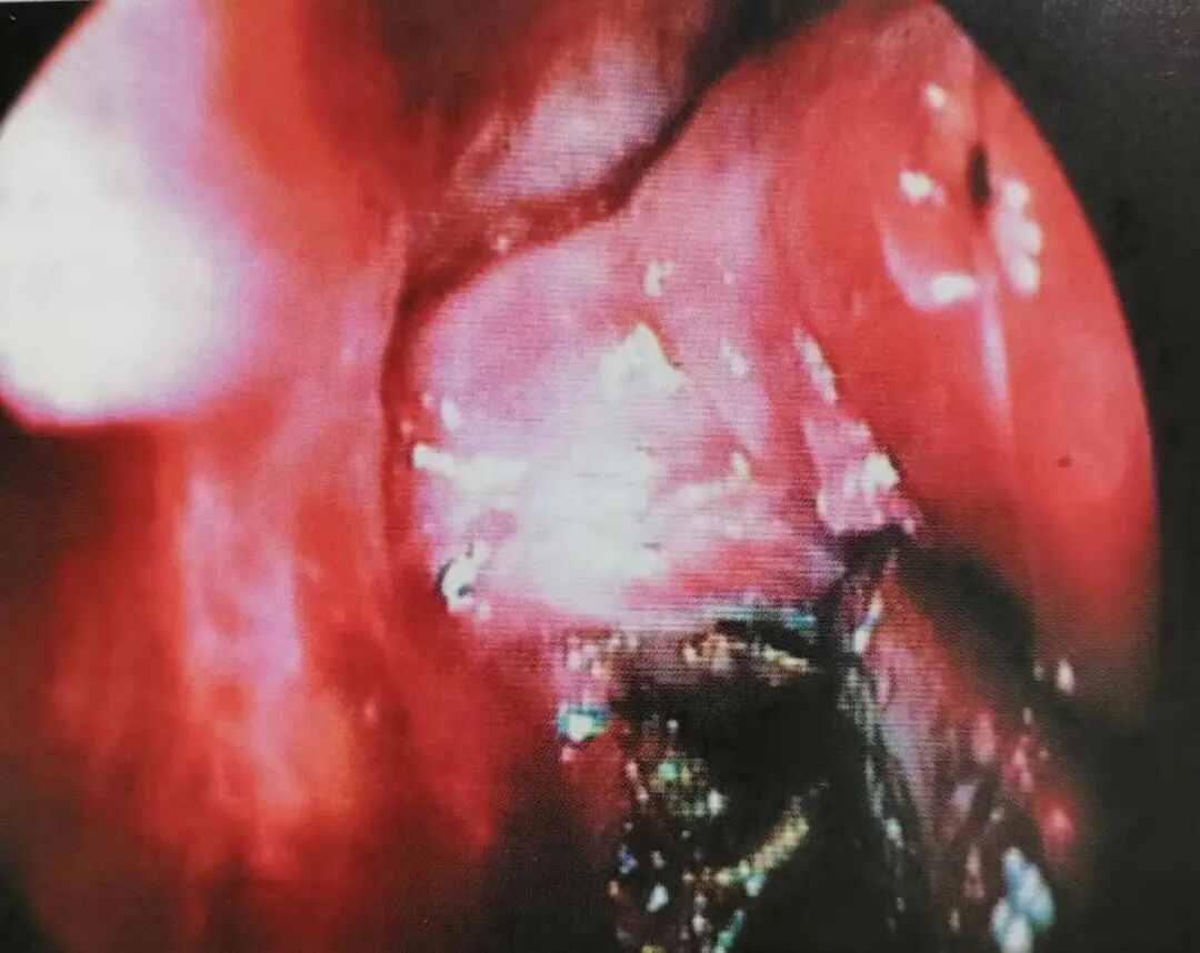 怎么结扎血管面对鼻出血：7种关键血管结扎手术技巧！_https://www.jmylbn.com_新闻资讯_第10张