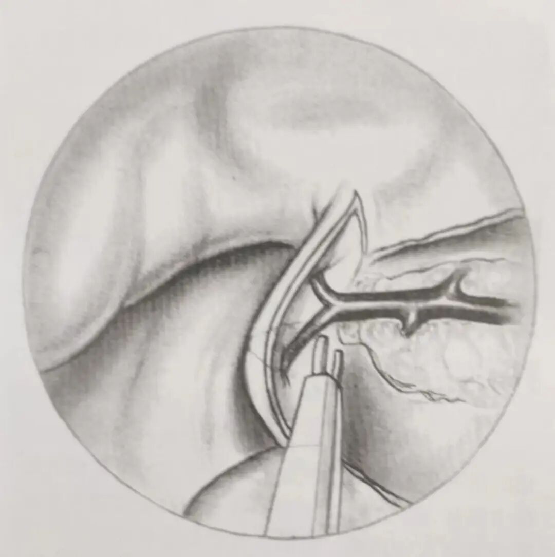 怎么结扎血管面对鼻出血：7种关键血管结扎手术技巧！_https://www.jmylbn.com_新闻资讯_第12张