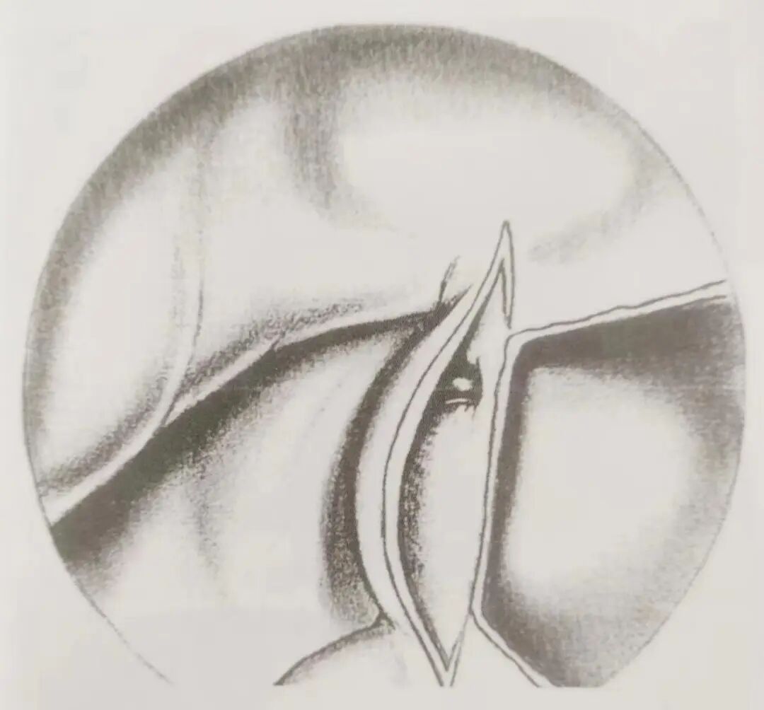 怎么结扎血管面对鼻出血：7种关键血管结扎手术技巧！_https://www.jmylbn.com_新闻资讯_第9张