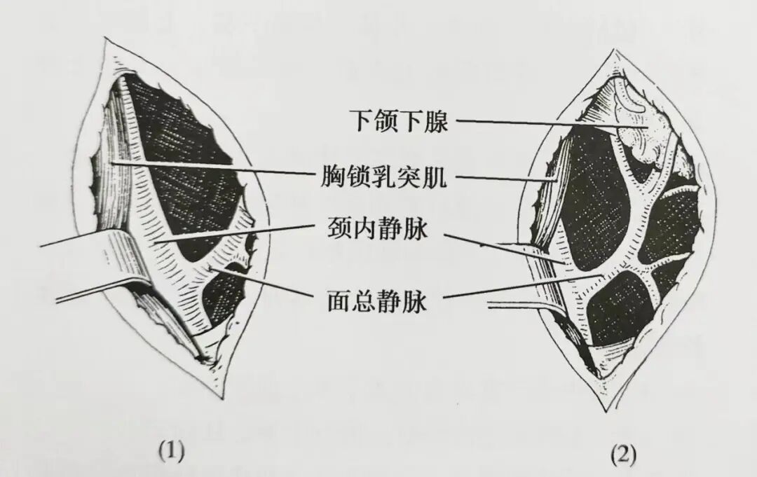 怎么结扎血管面对鼻出血：7种关键血管结扎手术技巧！_https://www.jmylbn.com_新闻资讯_第2张
