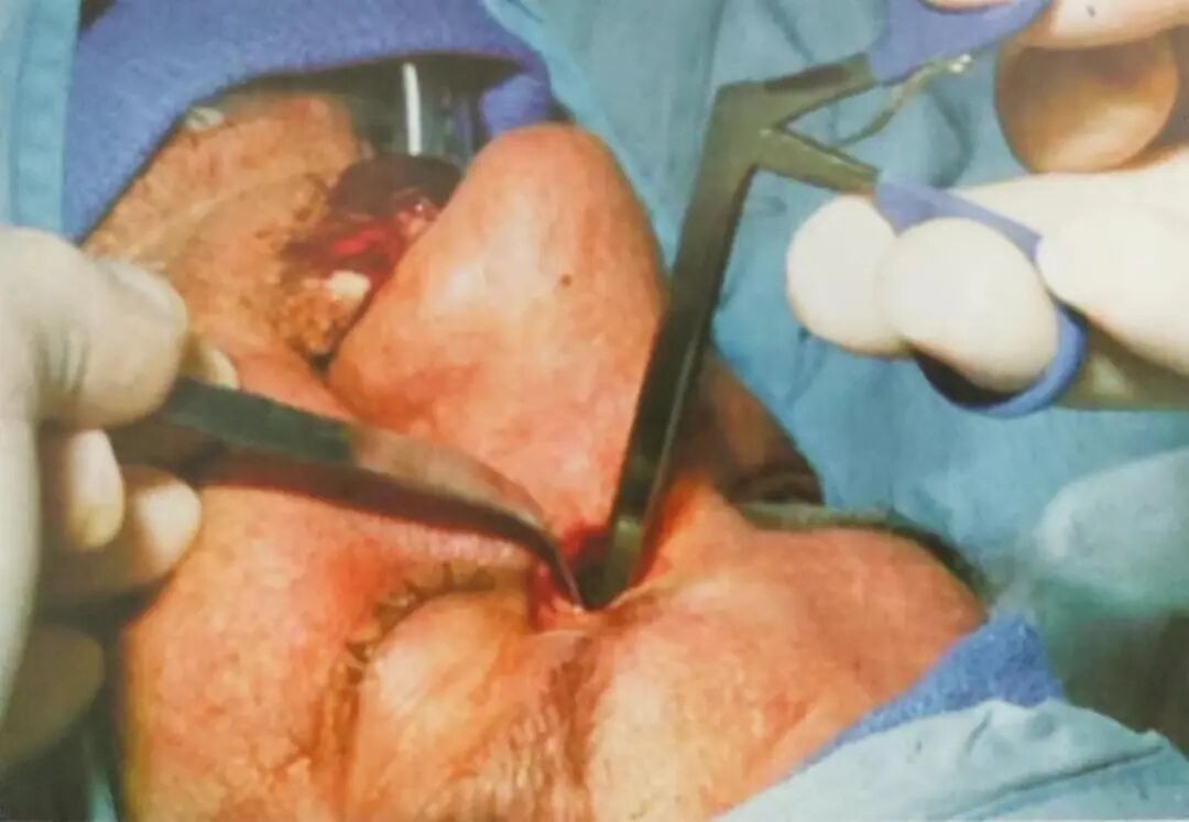 怎么结扎血管面对鼻出血：7种关键血管结扎手术技巧！_https://www.jmylbn.com_新闻资讯_第5张