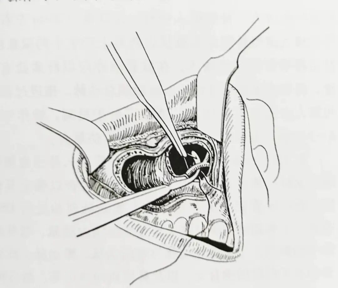 怎么结扎血管面对鼻出血：7种关键血管结扎手术技巧！_https://www.jmylbn.com_新闻资讯_第4张