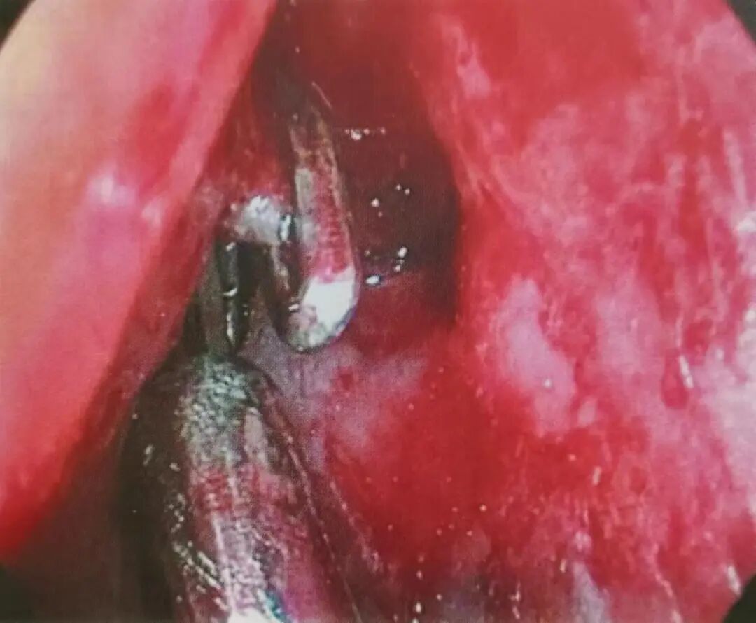 怎么结扎血管面对鼻出血：7种关键血管结扎手术技巧！_https://www.jmylbn.com_新闻资讯_第7张