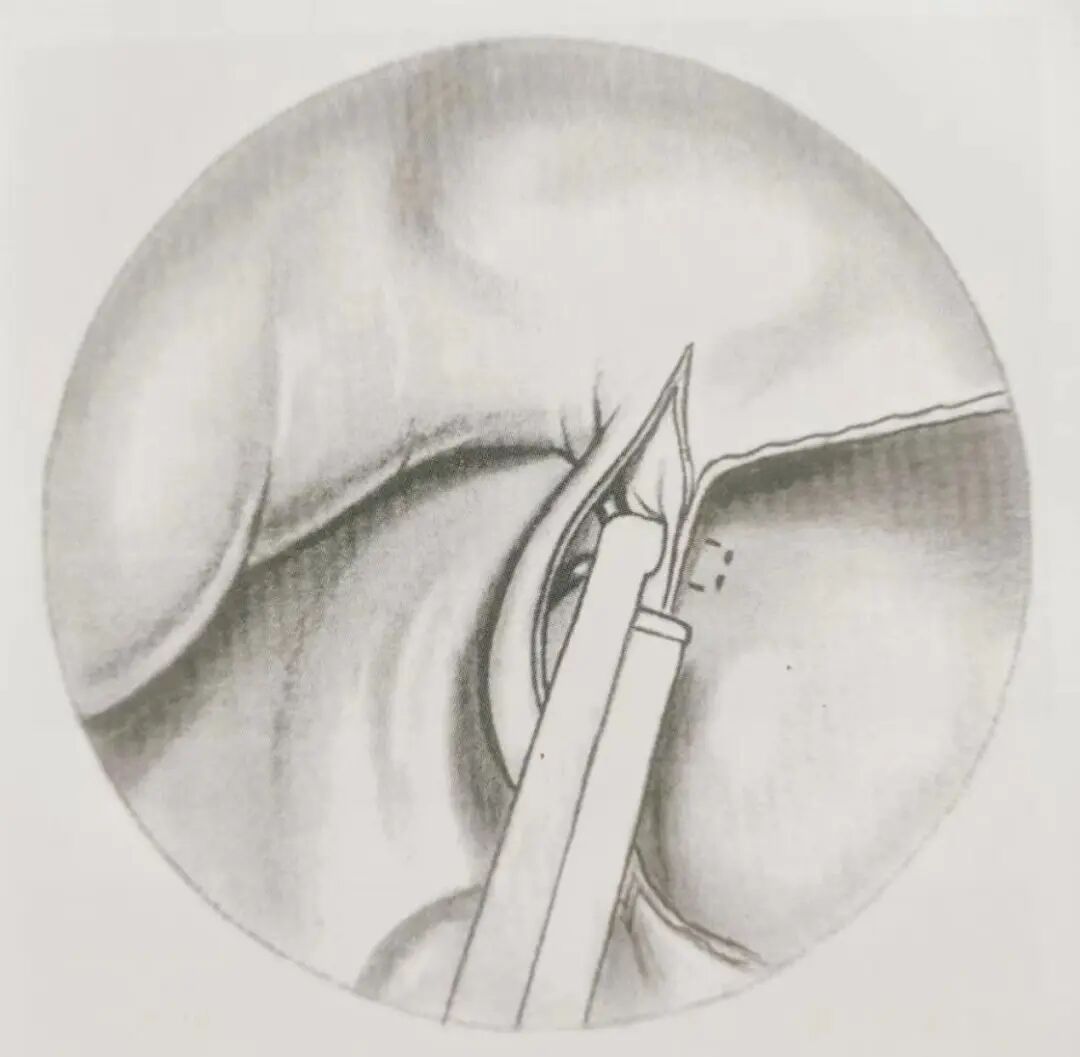 怎么结扎血管面对鼻出血：7种关键血管结扎手术技巧！_https://www.jmylbn.com_新闻资讯_第11张