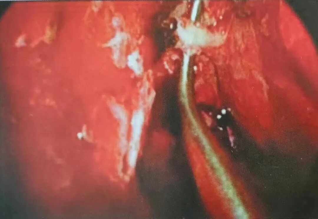 怎么结扎血管面对鼻出血：7种关键血管结扎手术技巧！_https://www.jmylbn.com_新闻资讯_第13张