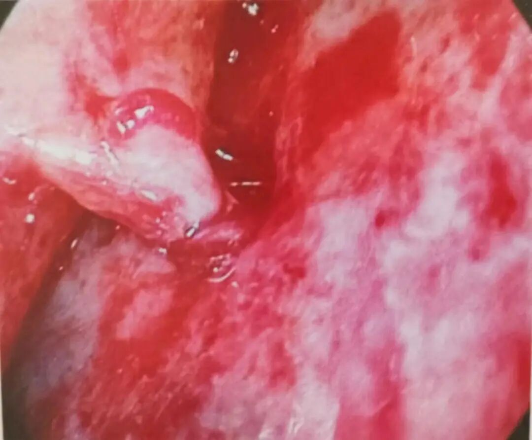 怎么结扎血管面对鼻出血：7种关键血管结扎手术技巧！_https://www.jmylbn.com_新闻资讯_第6张