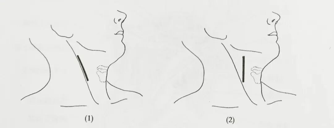 怎么结扎血管面对鼻出血：7种关键血管结扎手术技巧！_https://www.jmylbn.com_新闻资讯_第1张