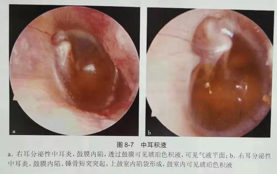 耳內镜下治疗儿童分泌性中耳炎 耳鼻喉健康讲堂 微信公众号文章阅读 Wemp