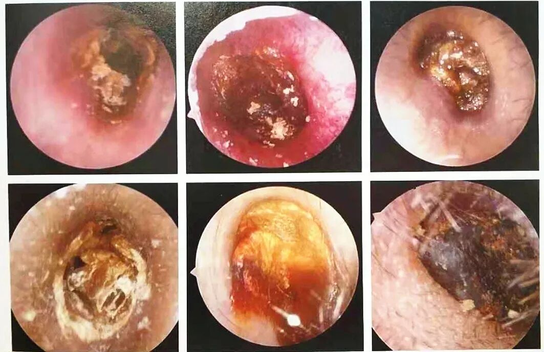 耵聍栓塞到底该怎样规范治疗