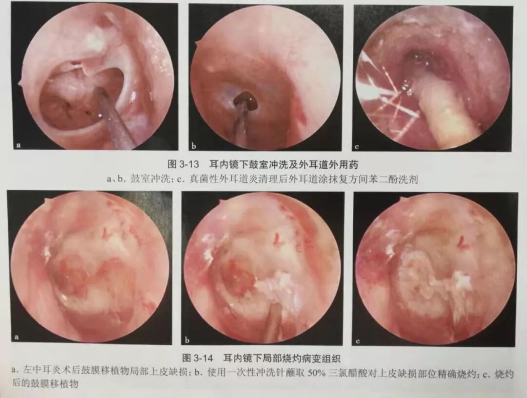没有耳镜怎么使用耳内镜的基本操作及注意事项_https://www.jmylbn.com_新闻资讯_第14张
