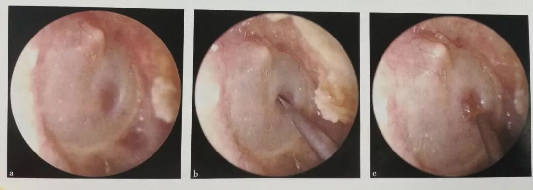 没有耳镜怎么使用耳内镜的基本操作及注意事项_https://www.jmylbn.com_新闻资讯_第19张