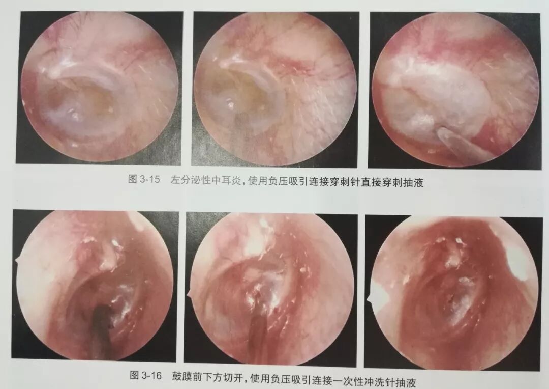 没有耳镜怎么使用耳内镜的基本操作及注意事项_https://www.jmylbn.com_新闻资讯_第15张