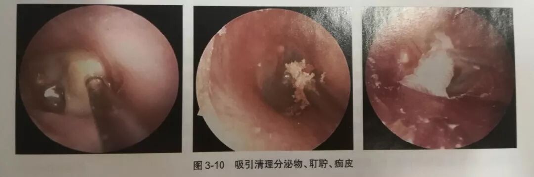 没有耳镜怎么使用耳内镜的基本操作及注意事项_https://www.jmylbn.com_新闻资讯_第11张