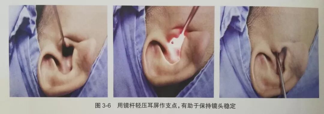 没有耳镜怎么使用耳内镜的基本操作及注意事项_https://www.jmylbn.com_新闻资讯_第7张