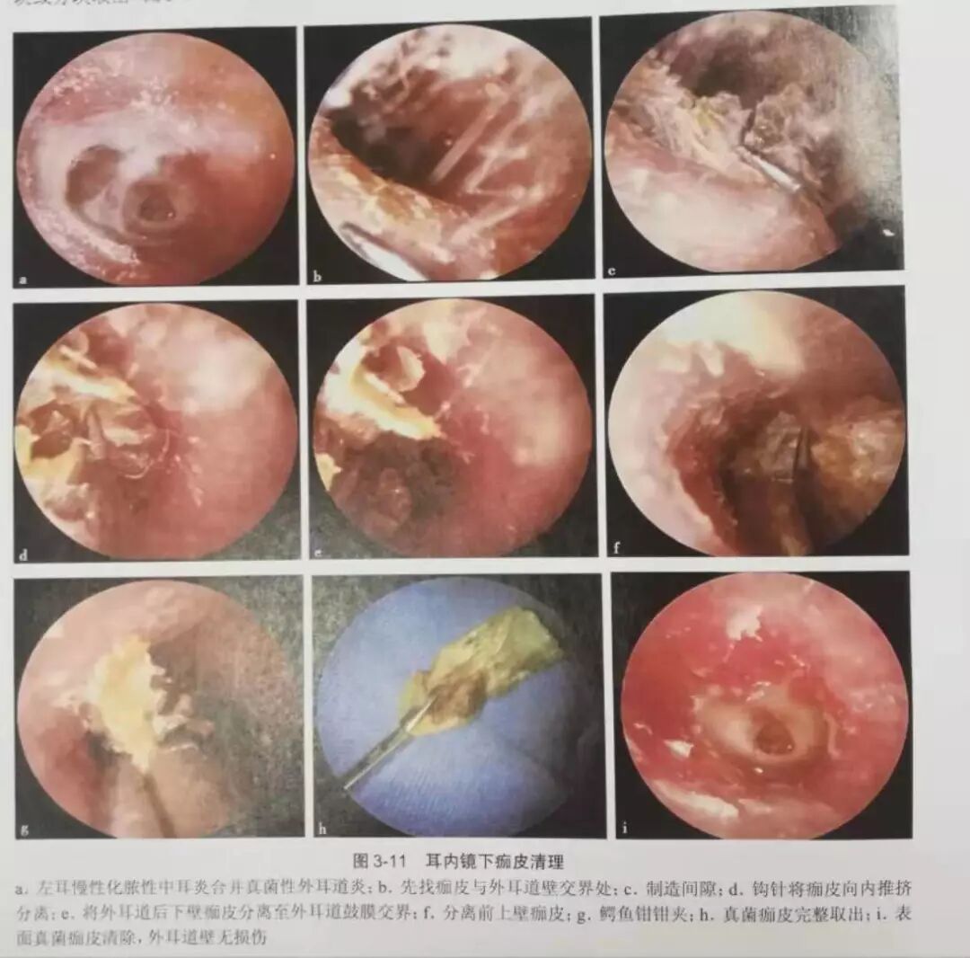 没有耳镜怎么使用耳内镜的基本操作及注意事项_https://www.jmylbn.com_新闻资讯_第12张