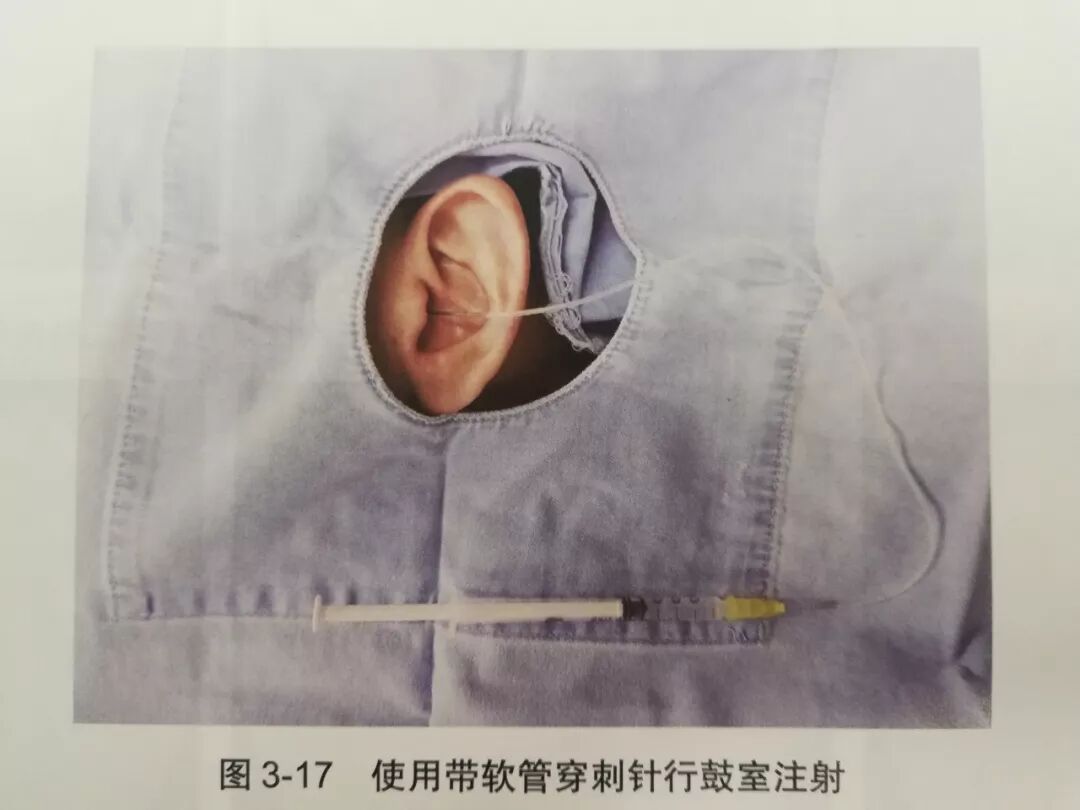 没有耳镜怎么使用耳内镜的基本操作及注意事项_https://www.jmylbn.com_新闻资讯_第16张