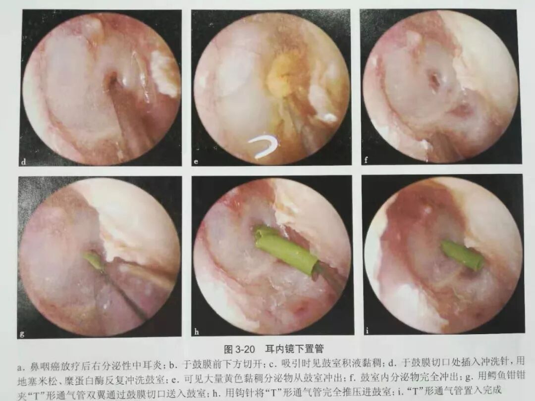没有耳镜怎么使用耳内镜的基本操作及注意事项_https://www.jmylbn.com_新闻资讯_第20张