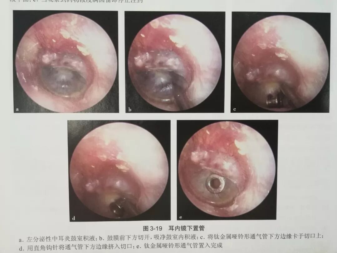 没有耳镜怎么使用耳内镜的基本操作及注意事项_https://www.jmylbn.com_新闻资讯_第18张