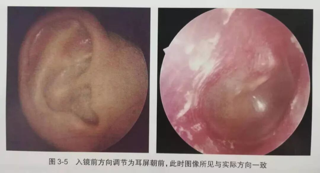 没有耳镜怎么使用耳内镜的基本操作及注意事项_https://www.jmylbn.com_新闻资讯_第6张