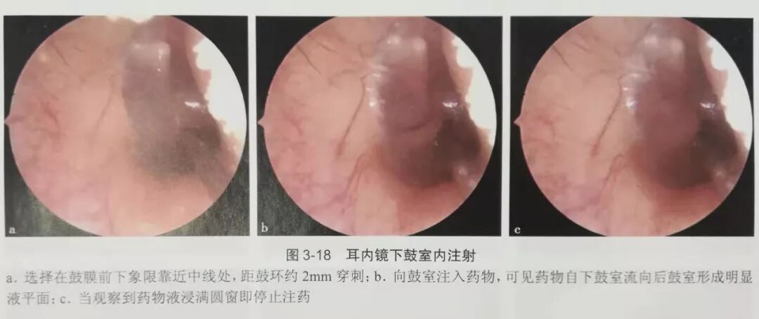 没有耳镜怎么使用耳内镜的基本操作及注意事项_https://www.jmylbn.com_新闻资讯_第17张