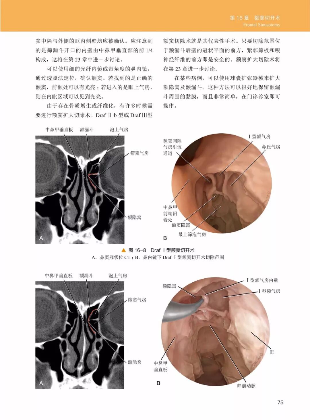 操作鼻窦镜时怎么摆30年鼻内镜手术独特经验！解剖标识、手术径路、外科操作技术还有比这更全的么？_https://www.jmylbn.com_新闻资讯_第14张