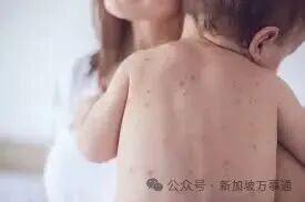 新加坡麻疹突增????麻疹症状、传播方式、防范重点全整理，这篇救命文请收好！ - ????????新加坡省钱皇后-皇后情报局