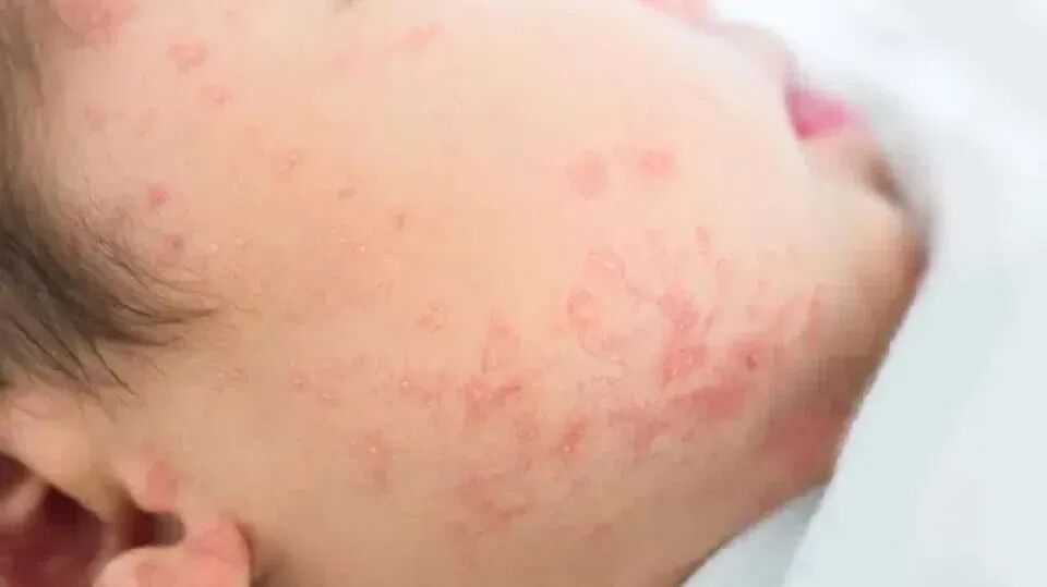 新加坡麻疹病例回升拜年庆团圆别忘了留心防范- 红蚂蚁