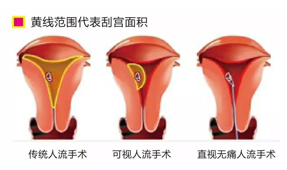 人流吸引管怎么选择爱康医院人流手术‖全程呵护子宫，全面护理，让你恢复如初_https://www.jmylbn.com_新闻资讯_第4张