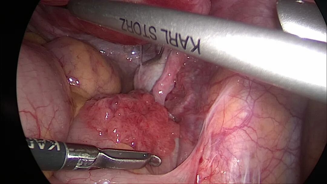 德国宫腔镜有什么牌子【微创时代】看不到疤痕的腹腔镜手术 开启妇产微创诊疗新“视”界！_https://www.jmylbn.com_新闻资讯_第10张