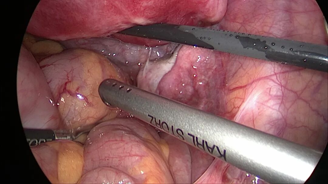 德国宫腔镜有什么牌子【微创时代】看不到疤痕的腹腔镜手术 开启妇产微创诊疗新“视”界！_https://www.jmylbn.com_新闻资讯_第11张