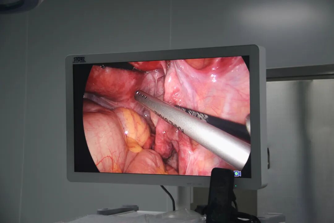 德国宫腔镜有什么牌子【微创时代】看不到疤痕的腹腔镜手术 开启妇产微创诊疗新“视”界！_https://www.jmylbn.com_新闻资讯_第9张