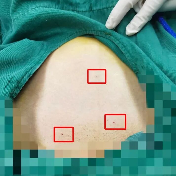 妇科微波是什么新技术推介 ｜ “针”微创 不开刀——我院成功开展首例超声引导下经皮子宫肌瘤微波消融术_https://www.jmylbn.com_新闻资讯_第3张