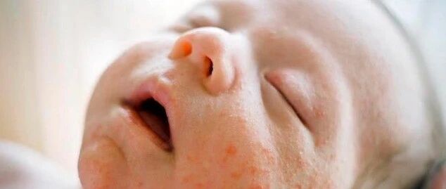宝宝又起疹子啦！教你区分和应对婴儿痤疮、脂溢性皮炎和湿疹！