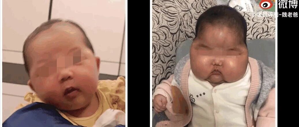 又出现“大头娃娃”了！快自查你家宝宝有没有用害人激素面霜！