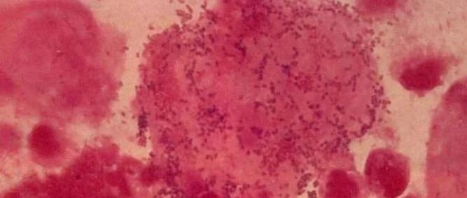 阴道炎能靠抵抗力自愈吗？