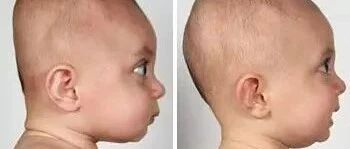 还在给宝宝睡头型？小心睡成头颅畸形，后悔终生！